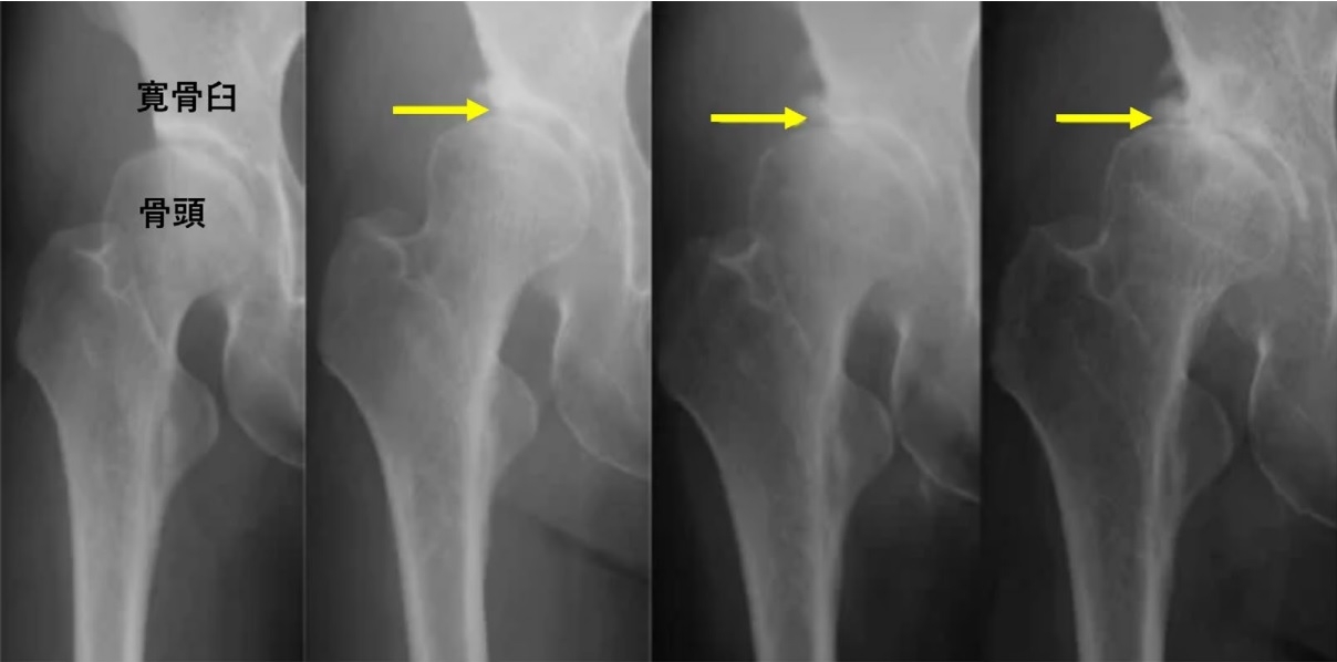 Family History of Developmental Dysplasia of the Hip is a Risk Factor for the Progression of Hip Osteoarthritis